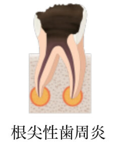 根尖性歯周炎の治療