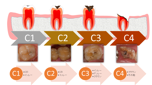虫歯の治療について
