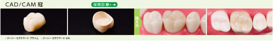 CAD/CAM 冠