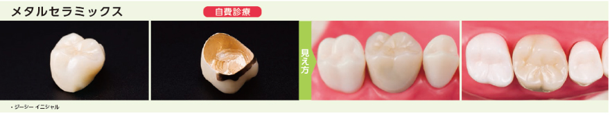 メタルセラミックス
