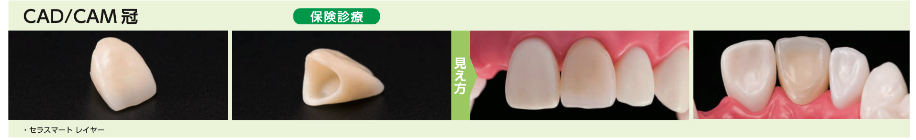 CAD/CAM 冠