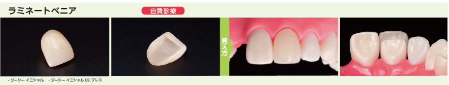ラミネートべニア