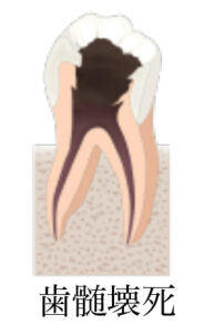 根尖性歯周炎の予防