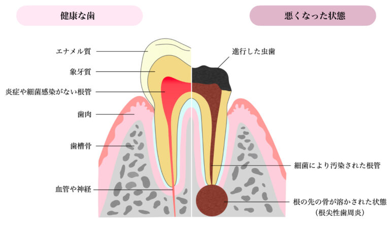 こんなときに根っこの治療（根管治療）が必要です！